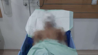 Korban penyiraman air keras saat dirawat di RSUPH Adam Malik, Kota Medan.