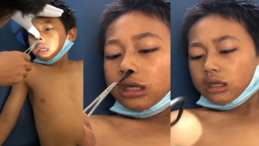 Viral Dokter Keluarkan Lintah dari Hidung Bocah