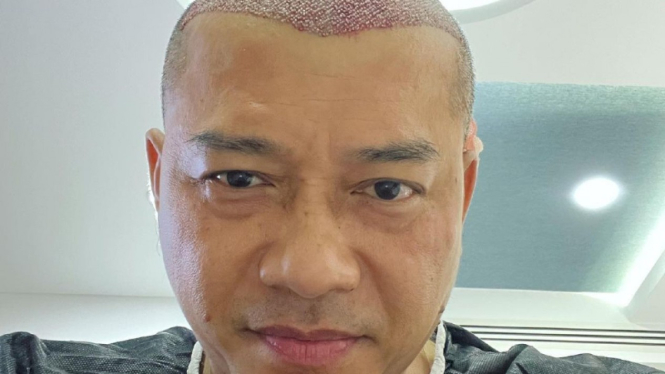 Anang Hermansyah lakukan transplantasi rambut.