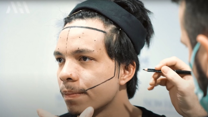 Transplantasi rambut