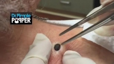 Dokter keluarkan komedo sebesar peluru.