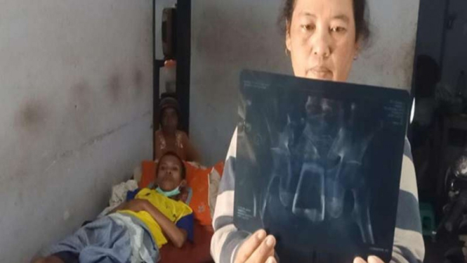 Kondisi Lasiadi, warga Jember yang di dalam perutnya ada gelas mulai membaik