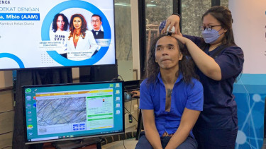 Kaka Slank lakukan transplantasi rambut