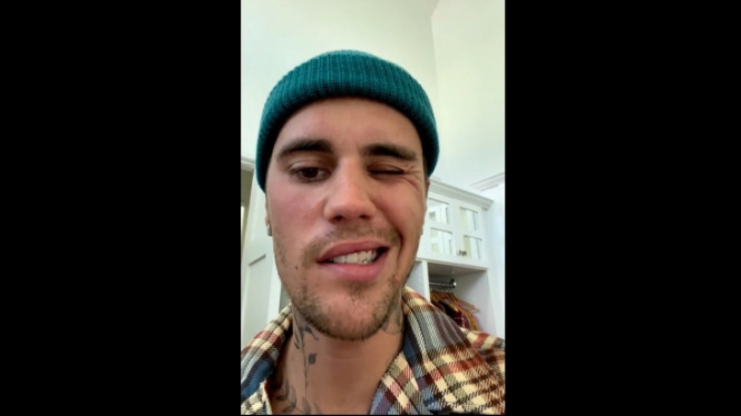 Justin Bieber kesulitan menggerakkan sebelah wajahnya akibat Ramsay Hunt
