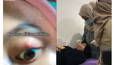 Viral wanita asal Depok yang mengalami bintitan hingga dioperasi