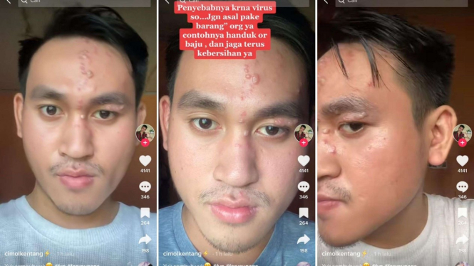 Curhatan seorang pria kena virus herpes zoster
