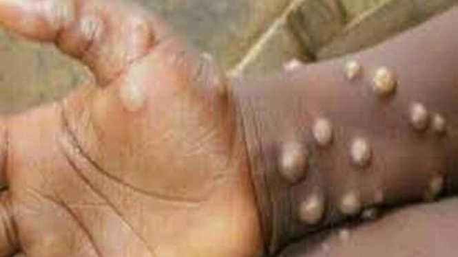 Monkeypox atau cacar monyet