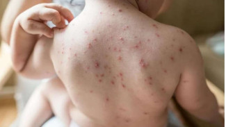 Waspada Lonjakan Kasus Cacar Air, Pakar Sarankan Jaga Imun dengan Cara Ini