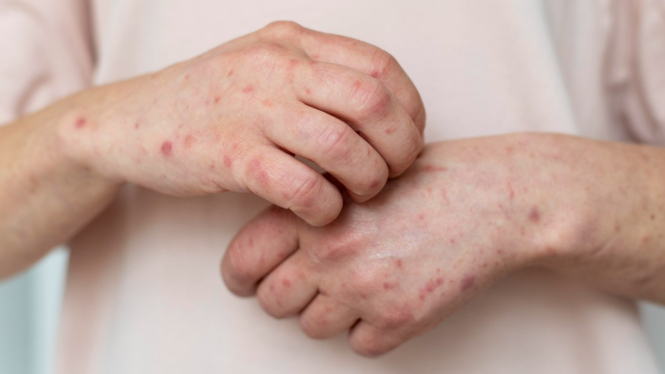 Ilustrasi cacar monyet/monkeypox.