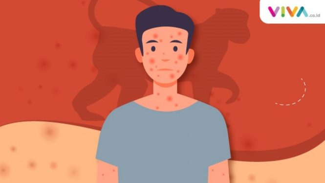 Infografik Cacar Monyet Masuk RI