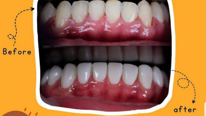 Direct veneer