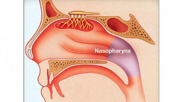 Kanker nasofaring