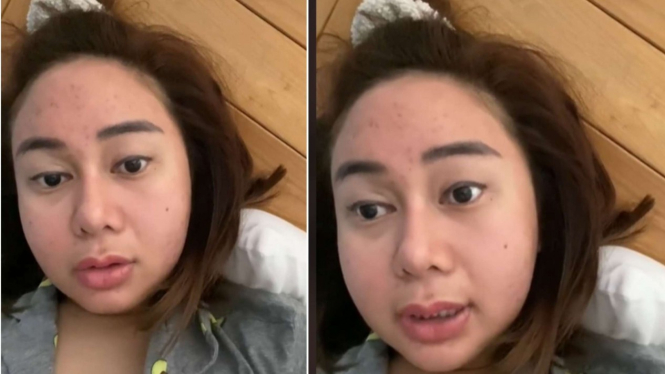 Muka Denise Chariesta bengep, apakah ini azab