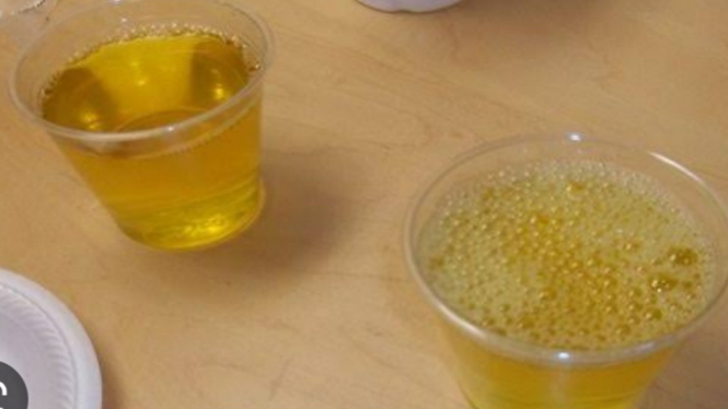 Urine berbusa