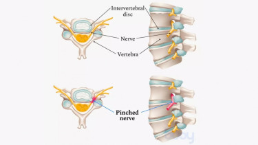 Saraf Kejepit atau pinched nerve