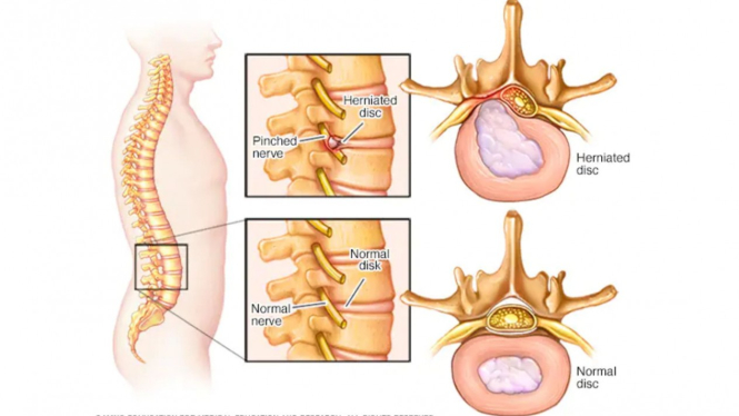 Saraf Kejepit atau pinched nerve