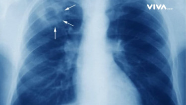Hasil pemeriksaan rontgen paru-paru terdapat tuberkulosis