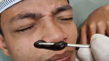 Lintah Hidup di dalam Hidung Pria di Bogor