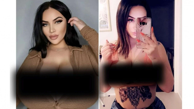 Payudara Pamela J yang terus membesar karena penyakit langka