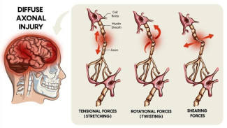 Apa Itu Diffuse Axonal Injury? Kondisi yang Dialami David Anak Pengurus GP Ansor