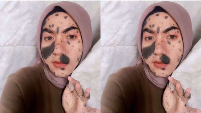 Kisah inspiratif Sabrina Fellani yang memiliki tanda lahir di sekujur tubuh