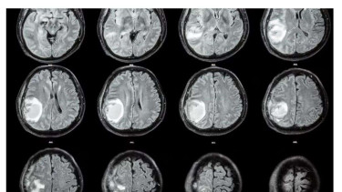 Hasil MRI otak bayi 