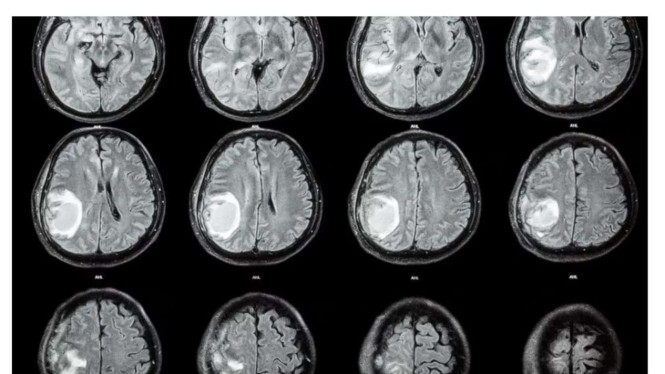 Hasil MRI otak bayi 