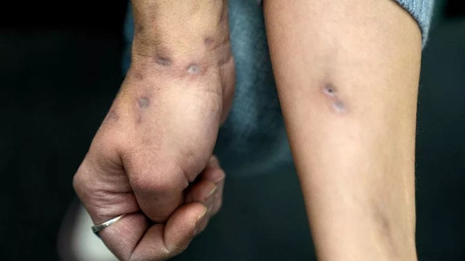 Efek narkotika jenis Xylazine atau obat zombie.