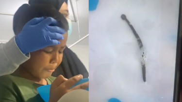Viral, Perjuangan Dokter Keluarkan Lintah yang Bersarang di Hidung Anak