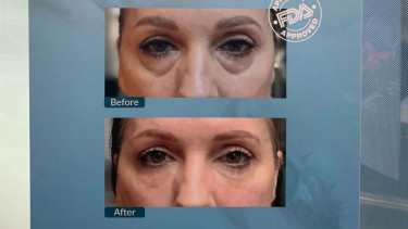Treatment EndoliftX