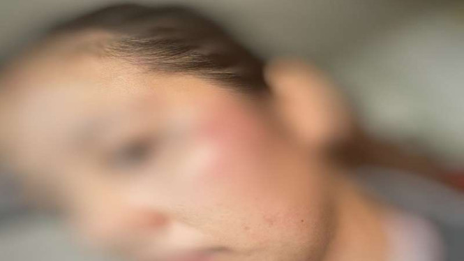 Korban penganiayaan anggota DPRD Takalar berinisial AG (30)