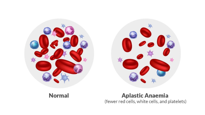 Anemia Aplastik
