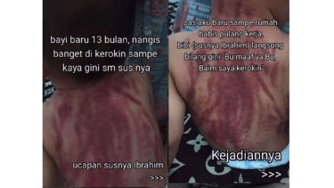Bayi 13 bulan dikerok oleh pengasuhnya