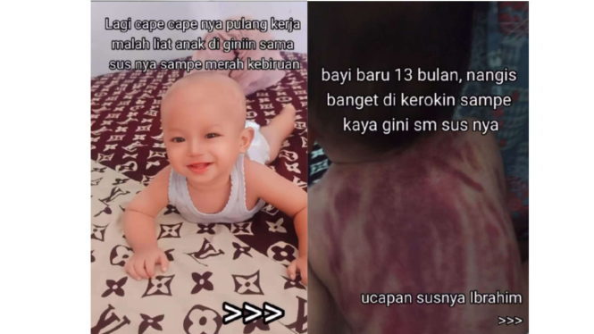 Bayi 13 bulan dikerok oleh pengasuhnya
