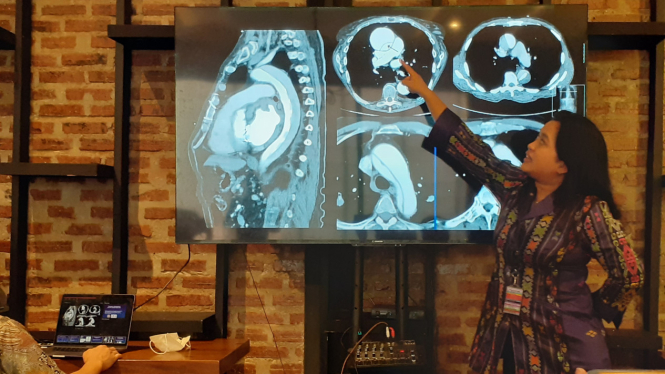 Ilustrasi diseksi aorta
