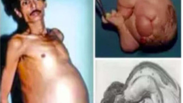 Pria Hamil dan Berhasil Lahirkan Anak di India
