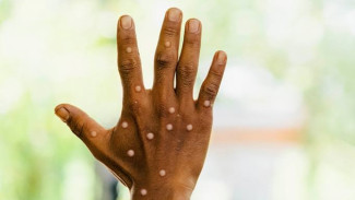 WHO Luncurkan Rencana Strategis Global untuk Atasi Wabah Mpox