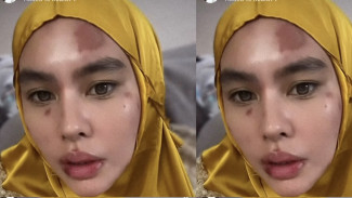 Kenali Gejala dan Penyebab Autoimun yang Dialami Artis Kartika Putri