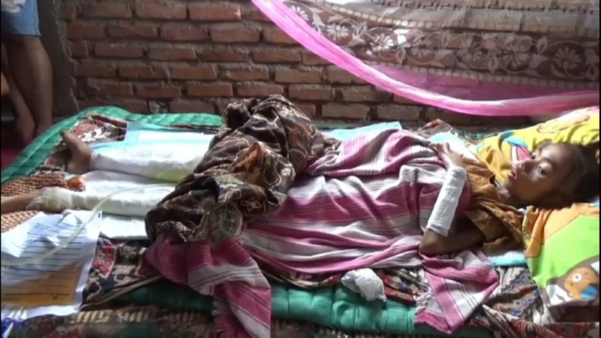 Adelia Rahma, bocah SD di Pariaman alami luka bakar dan gizi buruk