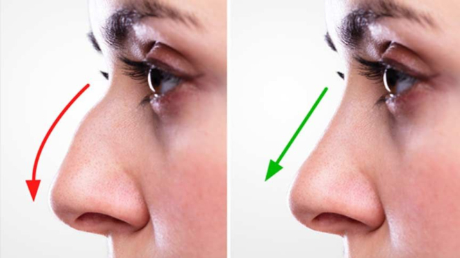 septorhinoplasty