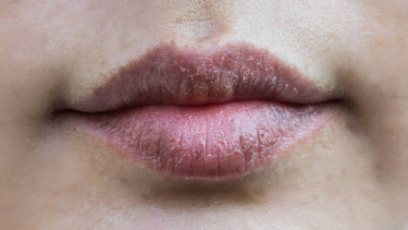 masalah bibir hitam dan kering