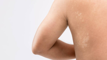 Panu di Badan