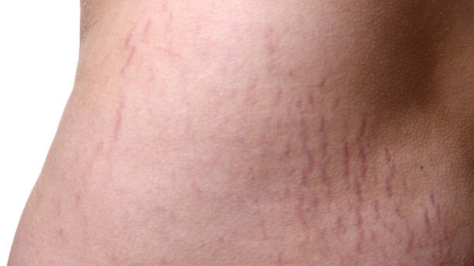 Stretch Mark