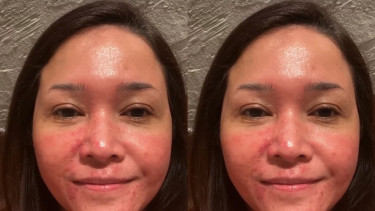 Maia Estianty menderita rosacea.