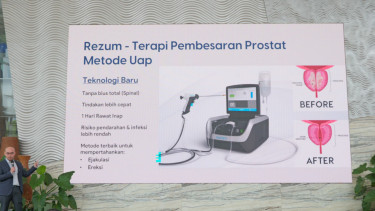 Rezum Water Vapor Prostate Therapy