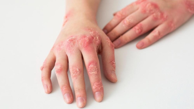 Ilustrasi Psoriasis