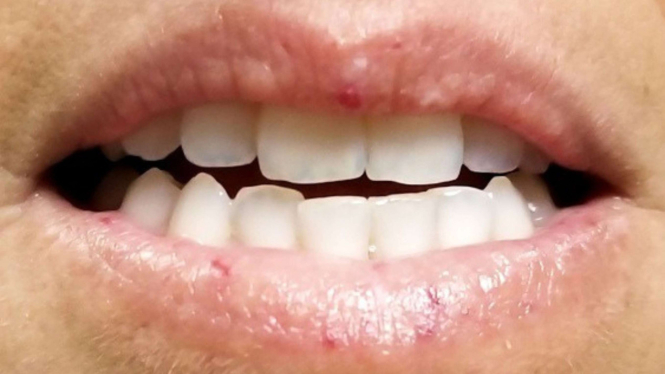 Bibir kasar dan beruntusan