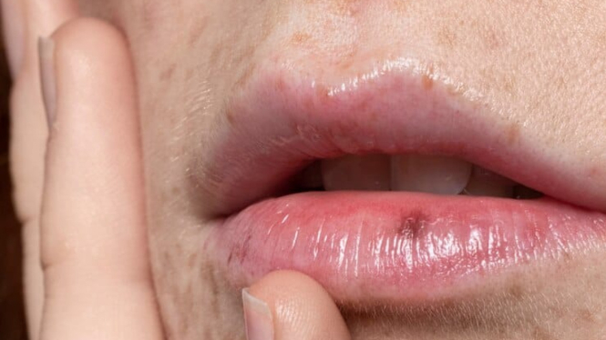 Ilustrasi jerawat di bibir