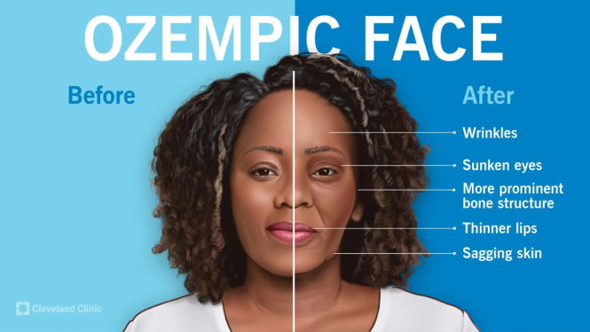 Ozempic Face