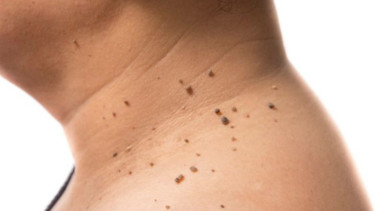 Ilustrasi skin tag